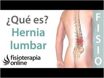 hernia hernia