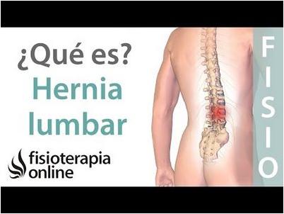 hernia