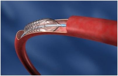 имплантаты