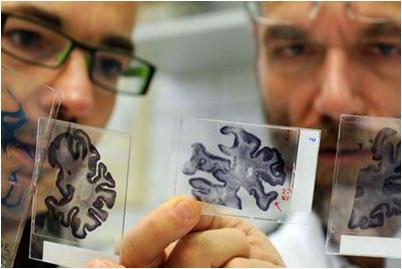 альцгеймера