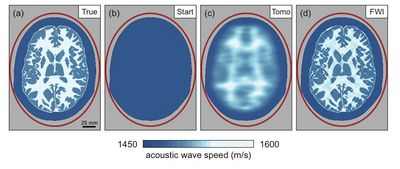 Исследования показывают, что технология SapC-DOPS может помочь в визуализации опухолей головного мозга