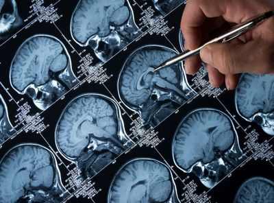 Недавно открытый процесс молекулярной обратной связи может защитить мозг от болезни Альцгеймера