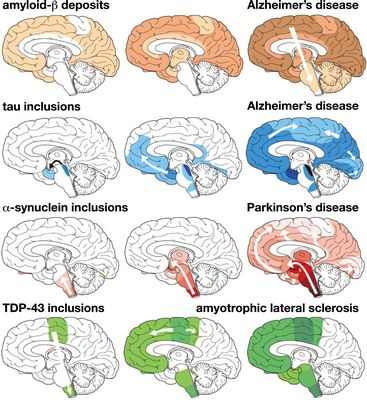 Нарушение сна связано с увеличением производства бета-амилоида